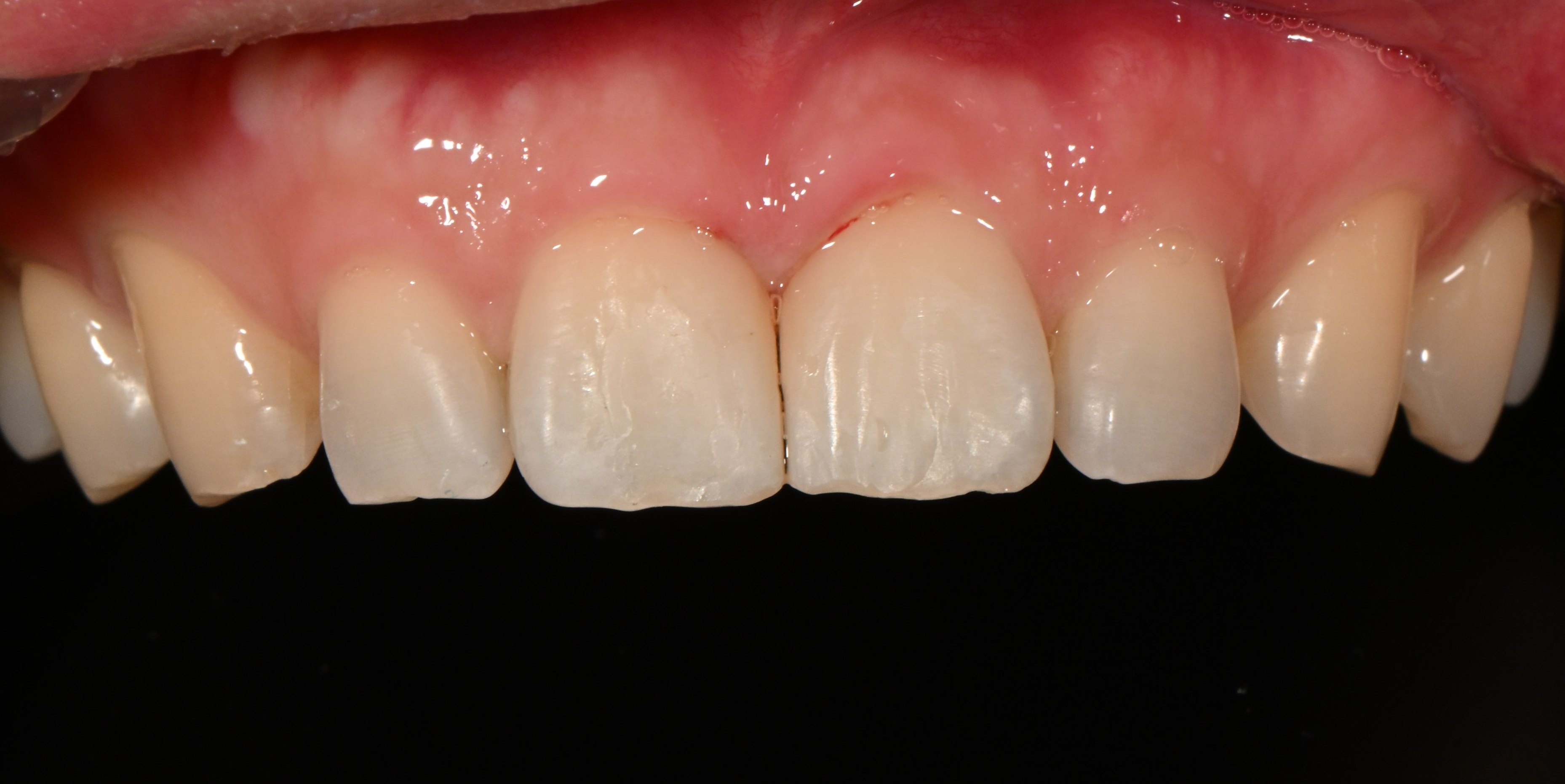 앞니 레진치료 (Diastema) 시술 후