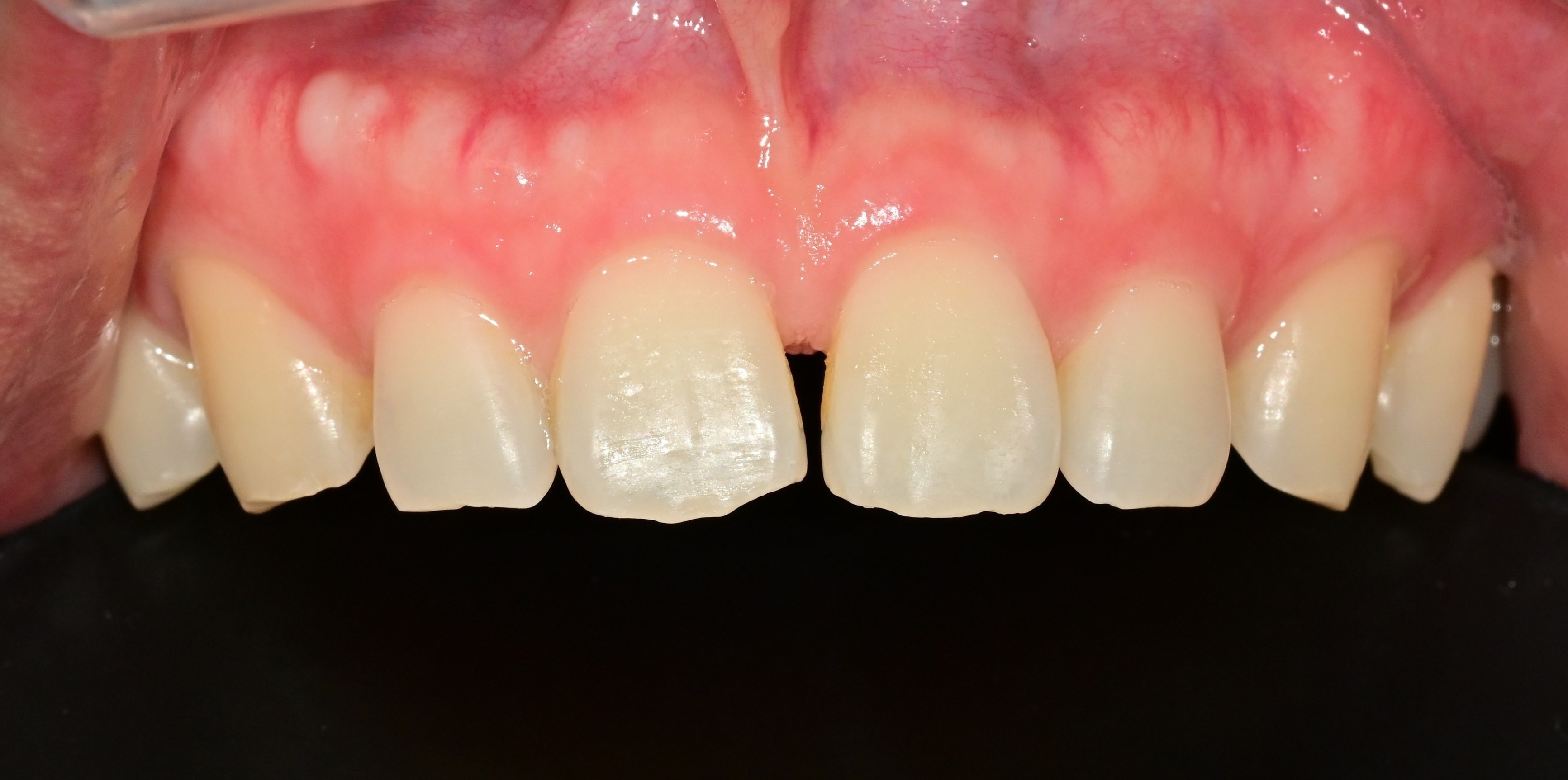 앞니 레진치료 (Diastema) 시술 전