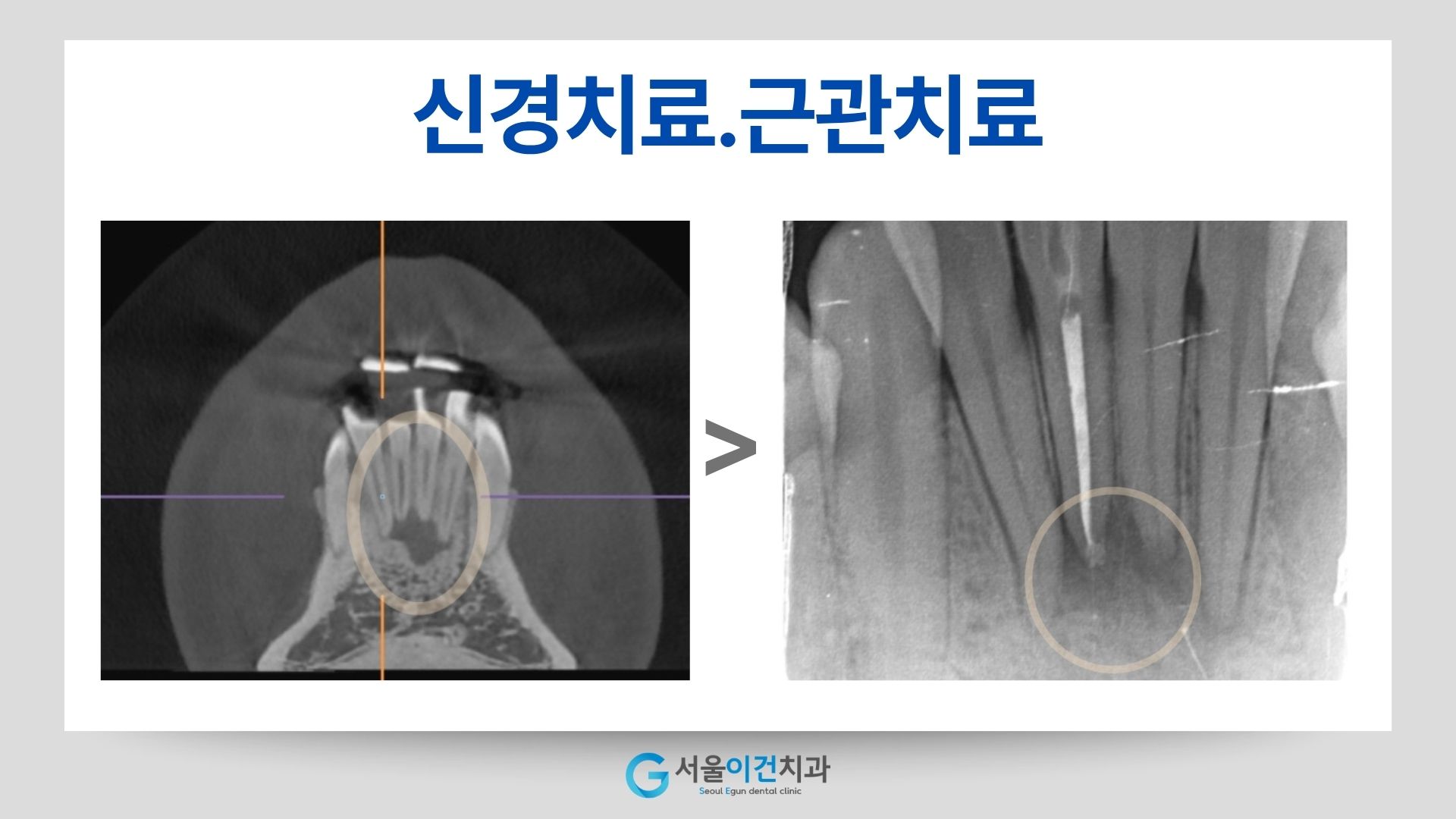 신경치료 사례의 CT와 치아 엑스레이: 치근 끝 부위 표시