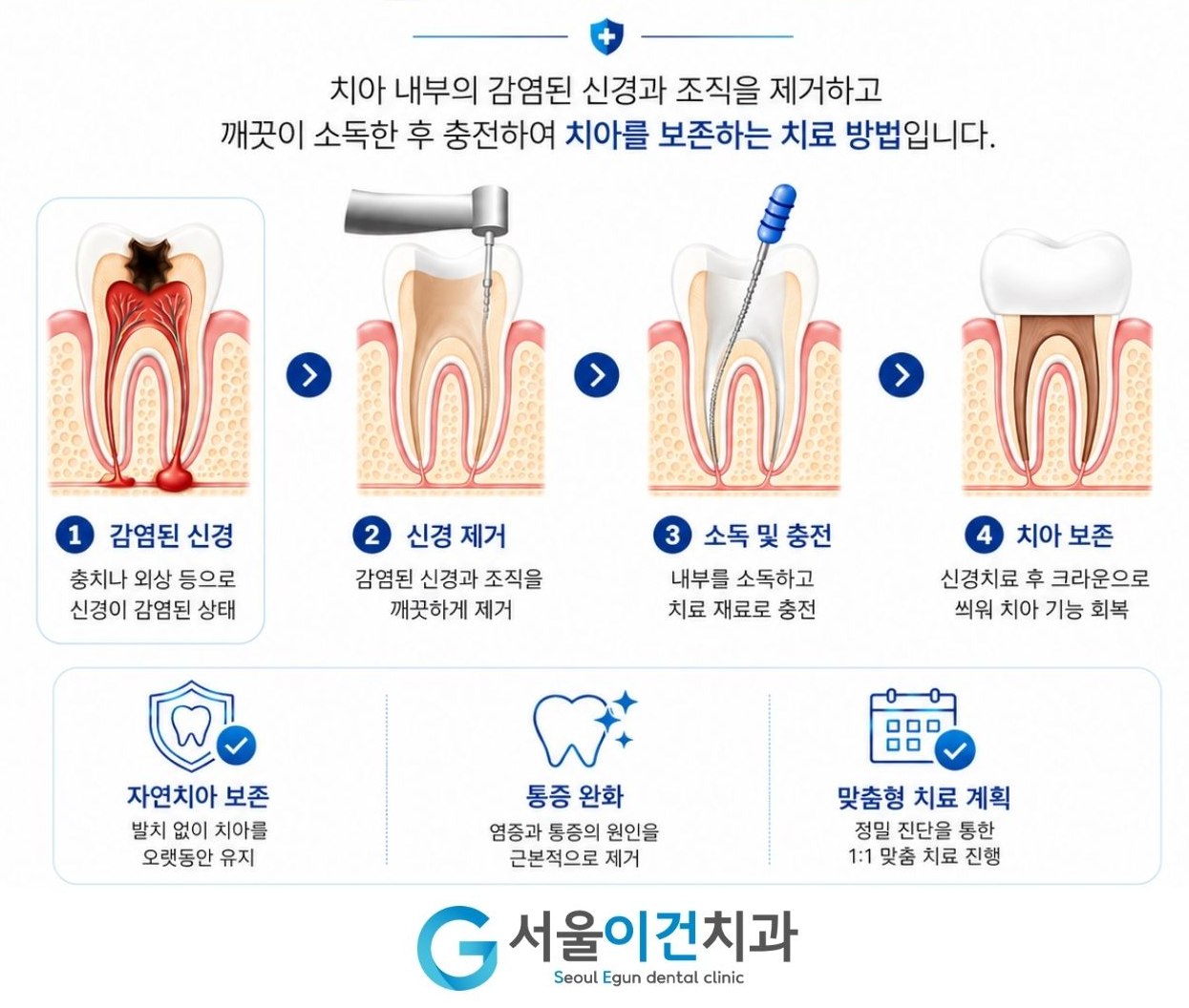 근관치료 (신경치료)
