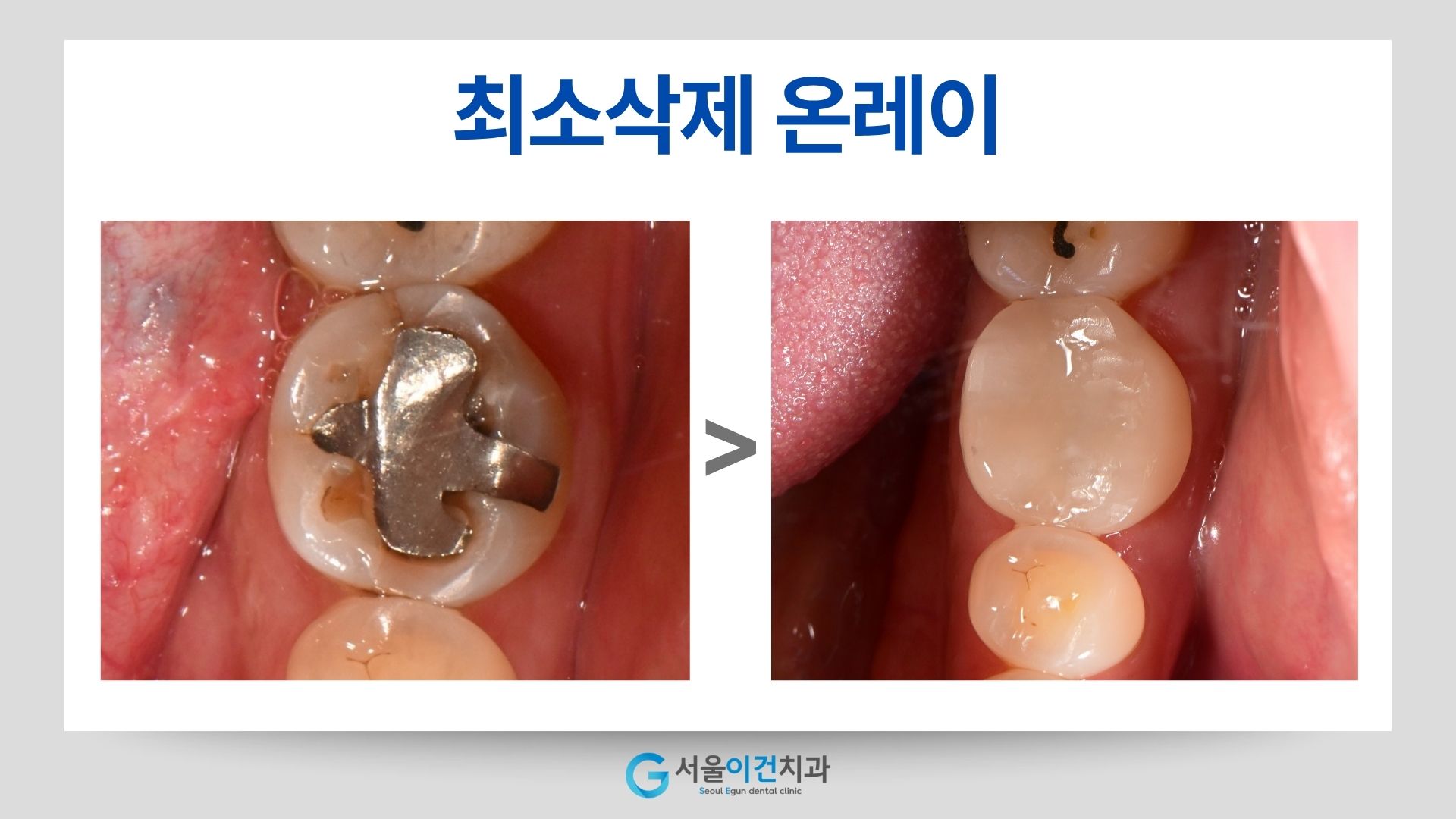 온레이 치료 전후 어금니 비교: 금속 수복물과 치아색 수복물