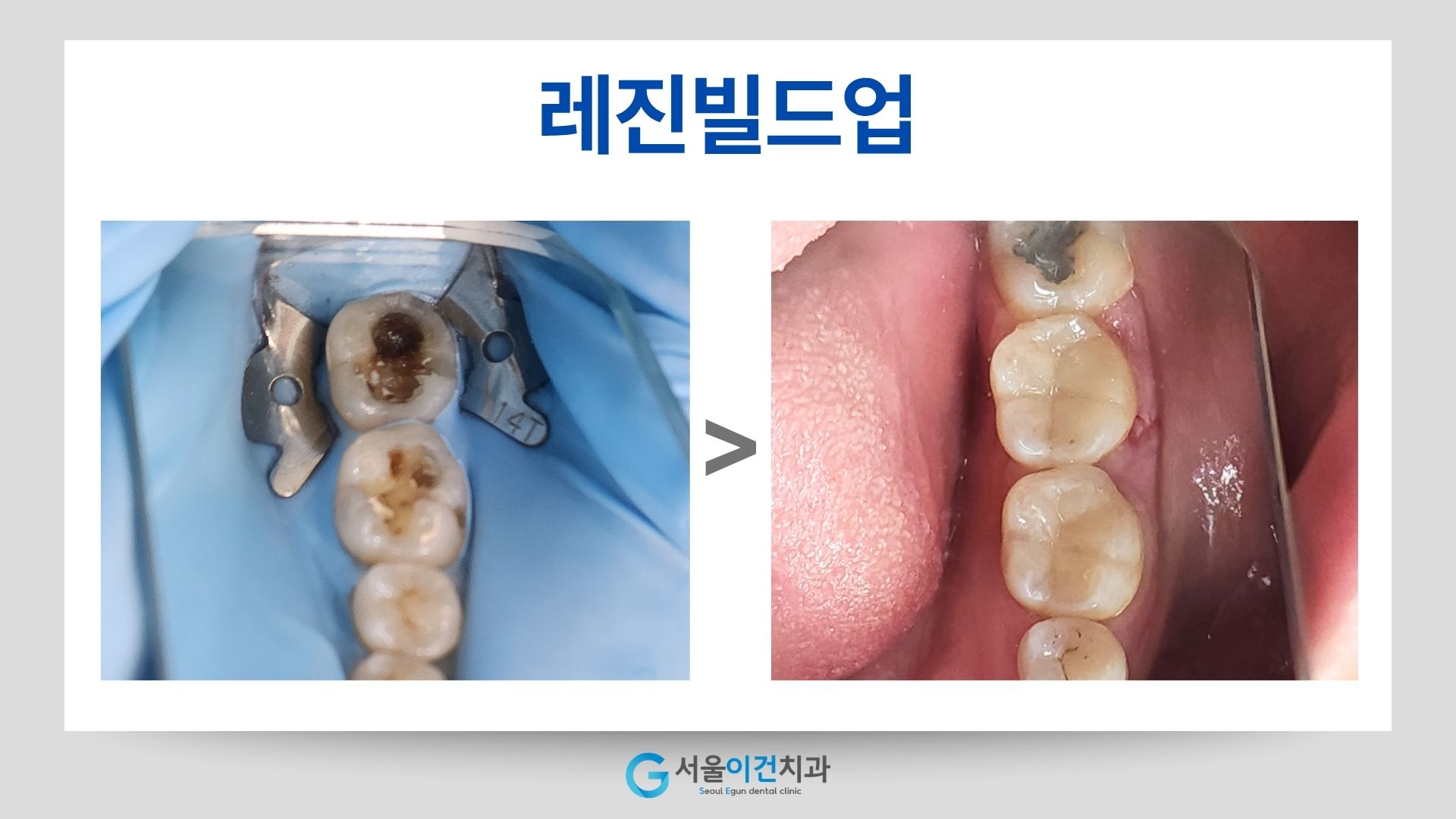 레진 빌드업 전후 어금니 비교 사진