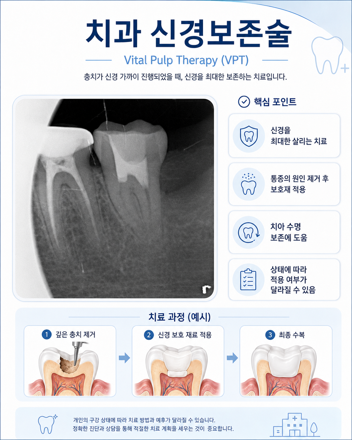 VPT 신경보존술