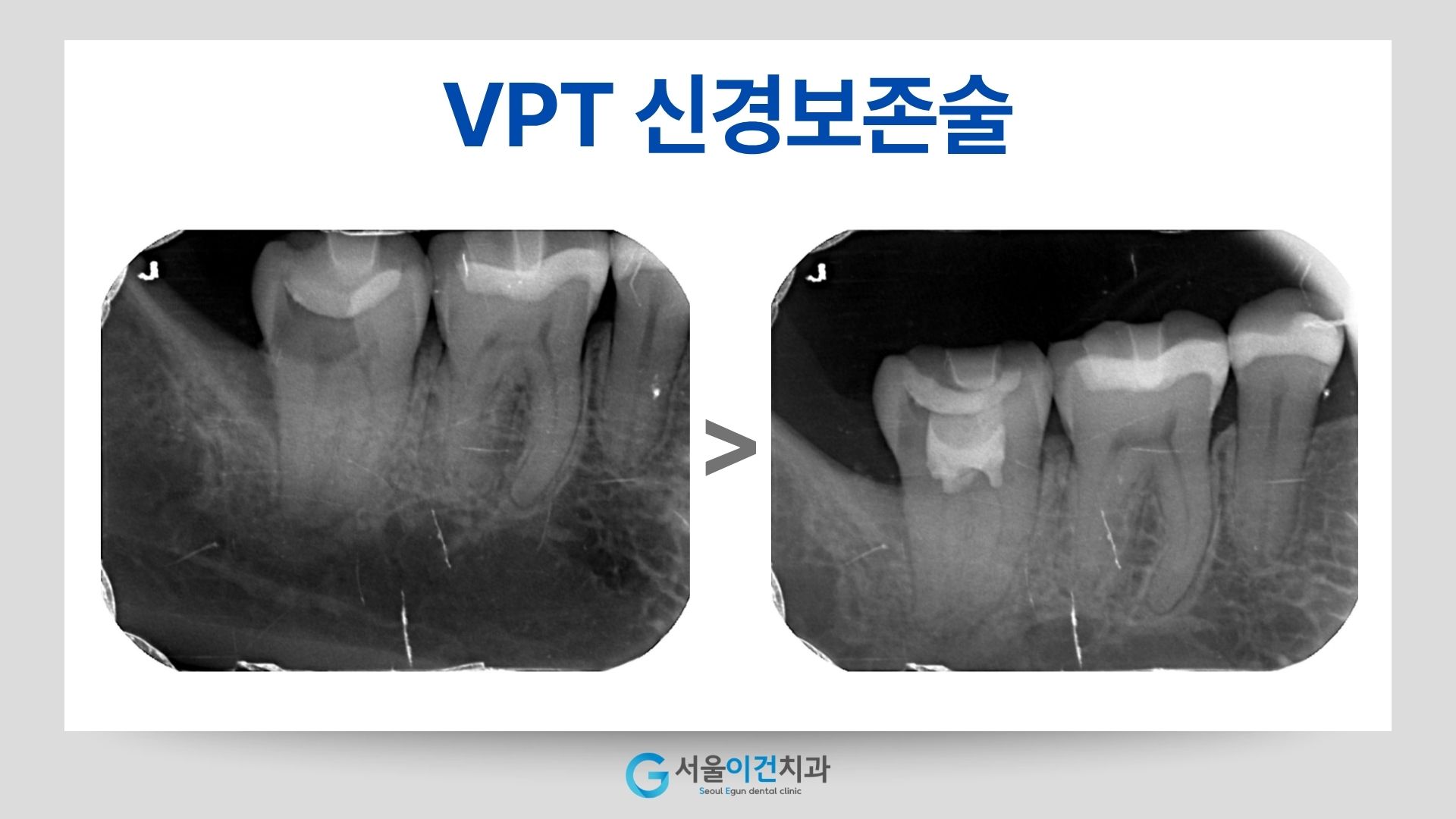 VPT 신경보존술 전후 치아 엑스레이 비교