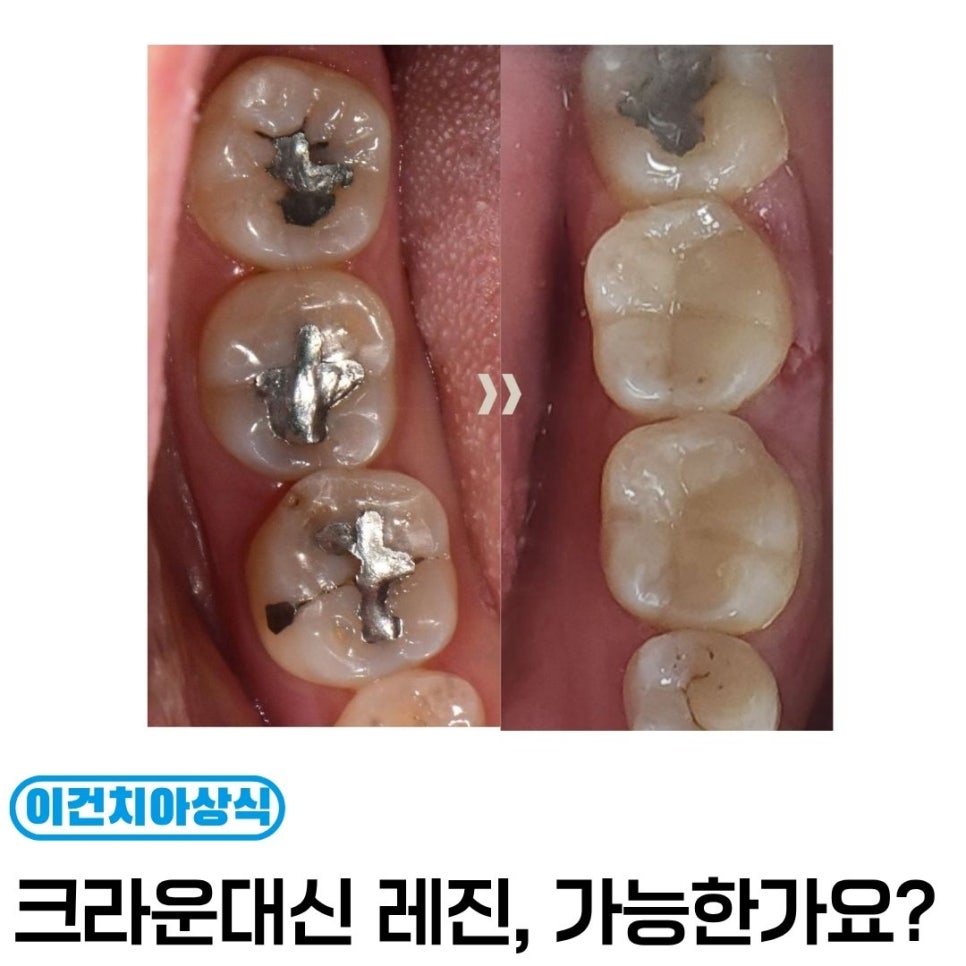 아말감 파절·레진 빌드업 사례